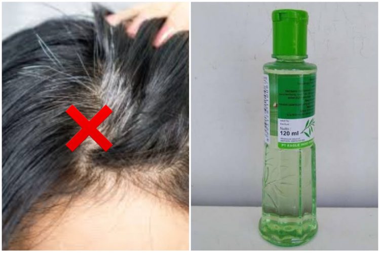 Ajaib, Ternyata Uban Bisa Hilang dengan Minyak Kayu Putih, Begini Caranya