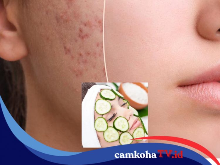 Rahasia Kecantikan Alami, 7 Bahan Alami Ini Bisa Bantu Atasi Jerawat, Yuk Coba