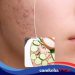 Rahasia Kecantikan Alami, 7 Bahan Alami Ini Bisa Bantu Atasi Jerawat, Yuk Coba