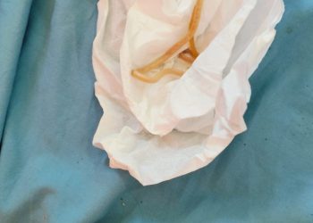 Begini Kronologis Khaira Balita di Seluma Bengkulu Mengeluarkan Cacing dari Mulut dan Hidung