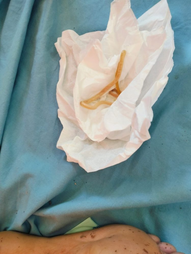 Begini Kronologis Khaira Balita di Seluma Bengkulu Mengeluarkan Cacing dari Mulut dan Hidung