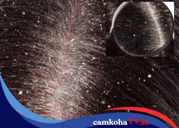 8 Cara Ampuh Menghilangkan Ketombe yang Bikin Gatal Kepala