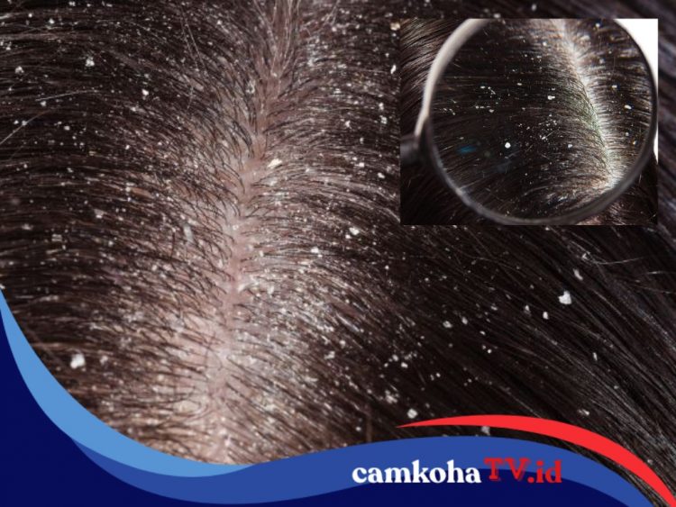 8 Cara Ampuh Menghilangkan Ketombe yang Bikin Gatal Kepala