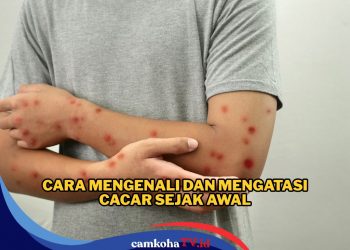 Lagi Ramai Kasus Santri Meninggal Diduga Terinfeksi Cacar Monyet, Begini Cara Mengenali Gejala dan Mengatasinya 