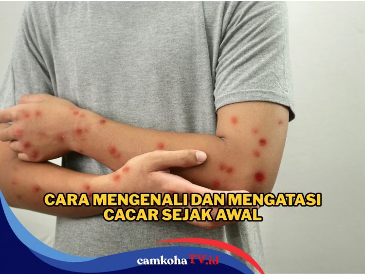 Lagi Ramai Kasus Santri Meninggal Diduga Terinfeksi Cacar Monyet, Begini Cara Mengenali Gejala dan Mengatasinya 