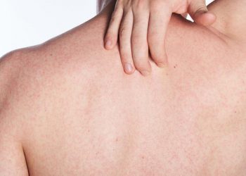 Kalau Punya Panu, Hindari Makanan dan Minuman Berikut, Panu Bisa Menyebar ke Seluruh Badan