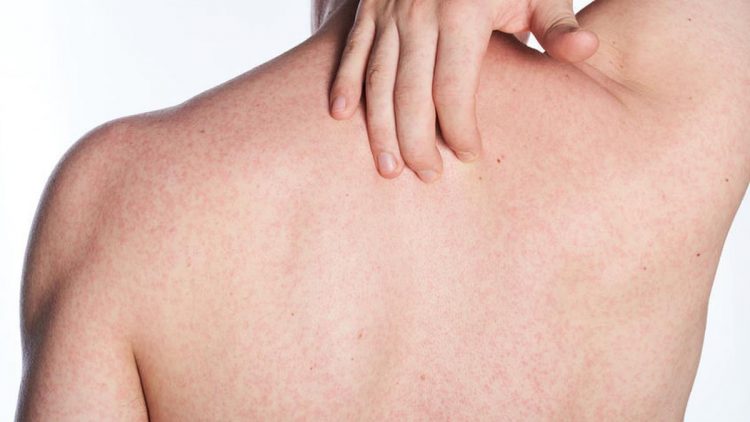 Kalau Punya Panu, Hindari Makanan dan Minuman Berikut, Panu Bisa Menyebar ke Seluruh Badan