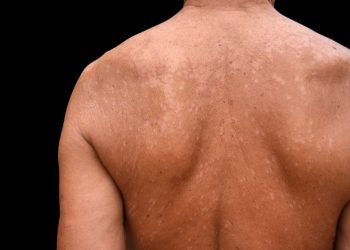 6 Merek Sabun Obat Panu, Harga Murah Khasiatnya Terbukti