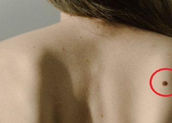 Banyak yang Punya Tahi Lalat di Pundak, Ternyata Ini Artinya Menurut Primbon Jawa