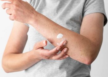 11 Tanaman Ini Mujarab Mengobati Panu, Banyak Ditanam di Pekarangan Rumah