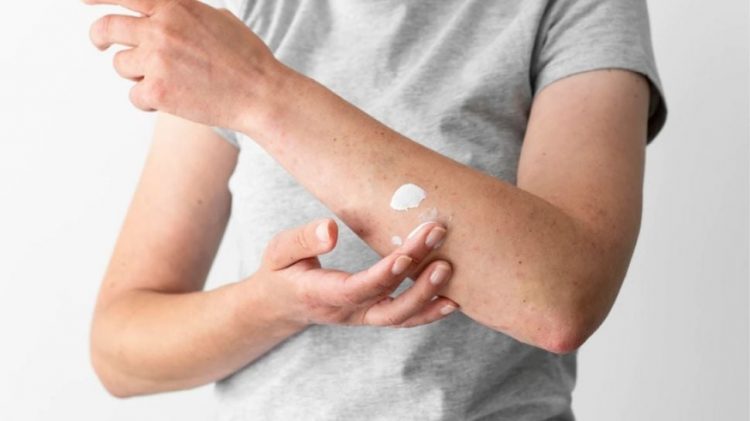 11 Tanaman Ini Mujarab Mengobati Panu, Banyak Ditanam di Pekarangan Rumah