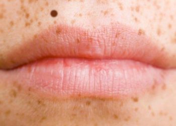 Anda Beruntung jika Punya Tahi Lalat di Bibir, Menurut Primbon Jawa Ini Artinya