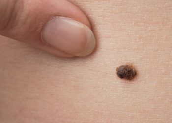 Kitab Primbon Jawa Arti Tahi Lalat di Daerah Sensitif Pria dan Wanita