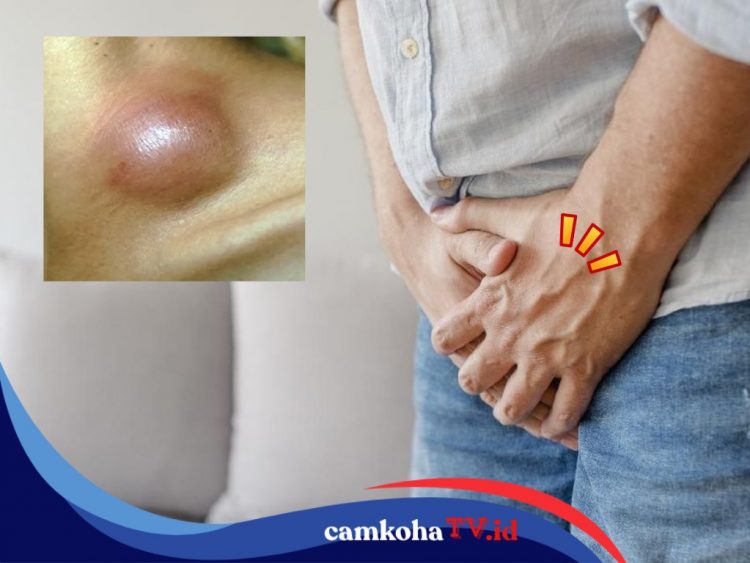 Kenali Ciri-cirinya, Berikut Gejala HIV pada Pria yang Perlu Diwaspadai