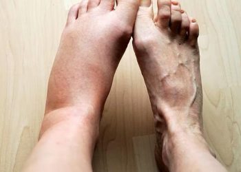 Bengkak karena Tertusuk Duri Sawit, Begini Cara Mengobatinya