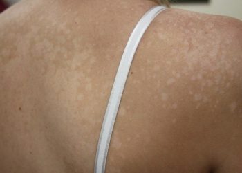 Daripada Malu, Obati Panu dengan Bahan Dapur Berikut Ini