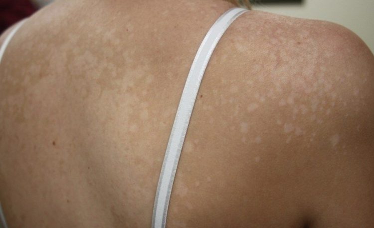 Daripada Malu, Obati Panu dengan Bahan Dapur Berikut Ini