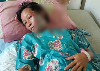 Di Bengkulu Ada Suami Tega Siram Air Panas ke Wajah Istri Hingga Melepuh