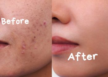 Jerawat Bikin Enggak Pede? Ini 5 Cara Alami Mengatasinya