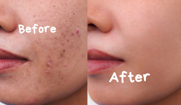 Jerawat Bikin Enggak Pede? Ini 5 Cara Alami Mengatasinya