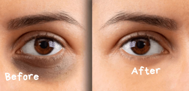 Cara Menghilangkan Mata Panda, Bikin Wajah Lebih Segar