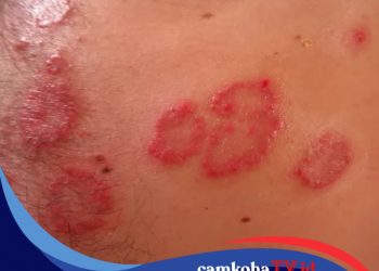 Alami dan Aman, 4 Cara Hilangkan Kurap Ini Efektif dan Cepat Sembuh